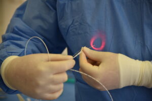 procedura žilní klinika - křečové žíly evlt